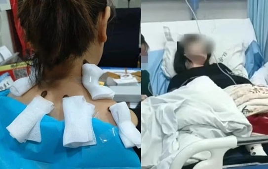 중국에서 거머리 흡혈 치료를 받은 여성이 고열을 동반한 전신 감염이 의심되어 치료를 받았다