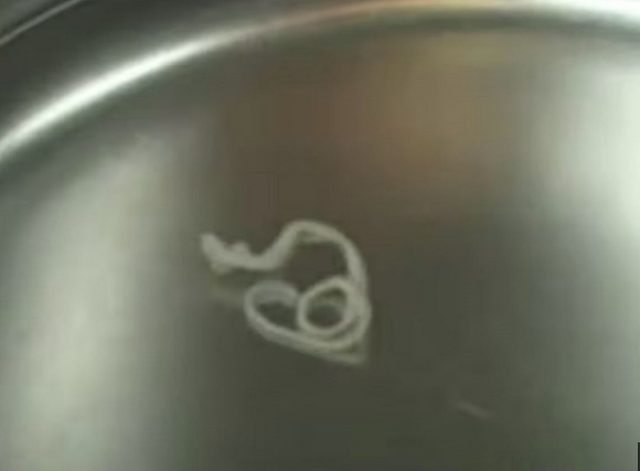 서울대병원 신경외과 백선하 교수와 순천향대서울병원 신경외과 박혜란 교수 공동 연구팀은 스파르가눔증 기생충 감염으로 서울대병원에 내원한 40대 여성 환자의 병변을 정밀하게 진단하고 개두술을 통해 살아 있는 기생충을 성