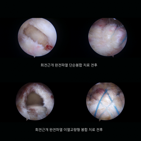 회전근개 완전파열은 양상에 따라 다양한 방법으로 수술할 수 있다 (사진=연세사랑병원 제공)