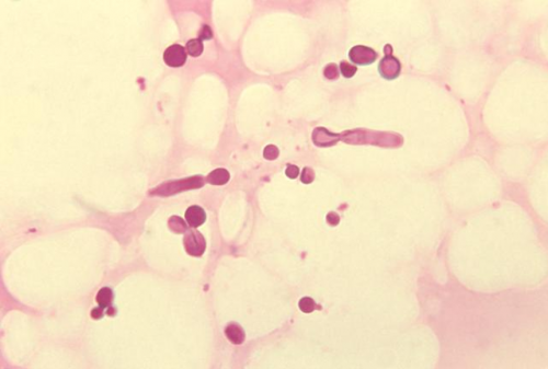 피부염을 앓고 있는 환자에서 포착된 말라세지아 곰팡이.출처: CDC