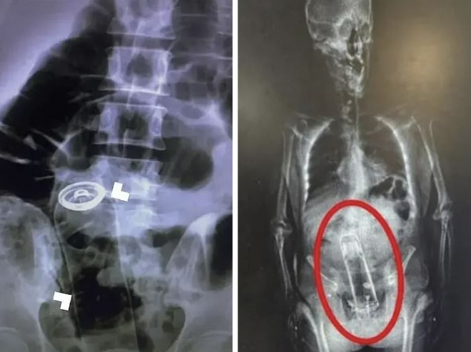 항문에 삽입한 데오드란트 캔으로 응급 수술을 받은 이란 남성 사례(왼쪽)와 항문에 보온병을 넣은 채 체포된 플로리다 남성의 신체 스캔 이미지(오른쪽).응급의학저널·폴크카운티 보안관 사무소
