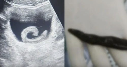 중국의 한 20대 남성의 방광에서 살아 있는 거머리가 발견돼 의료진이 긴급 제거에 나섰다.바이두 캡처