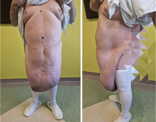 35kg 복부 종양 제거 수술…무릎까지 쳐졌었다니 ㄷㄷ