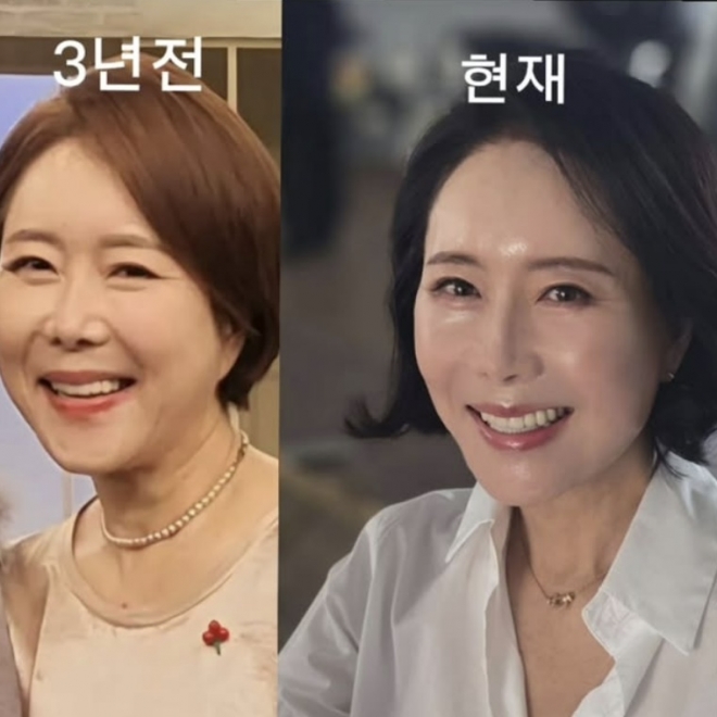 아나운서 출신 방송인 윤영미(63)가 안면거상술 후 확 달라진 얼굴을 공개했다.윤영미 인스타그램 캡처