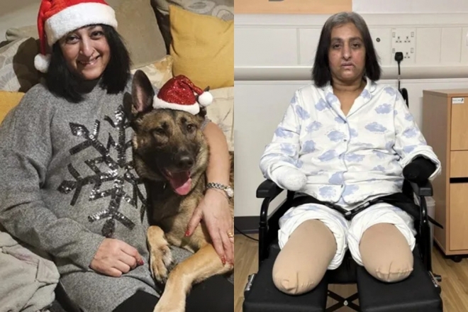 반려견과 놀아준 뒤 패혈증에 걸려 사지를 절단한 영국 여성 만짓 상하. 고펀드미 등 캡처