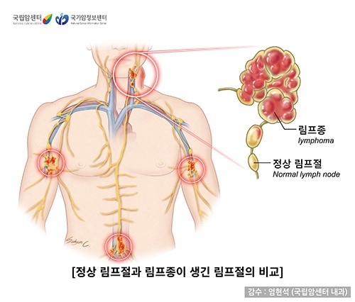 정상 림프절과 림프종이 생긴 림프절의 비교.자료 : 국립암센터