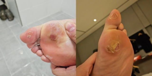 안세영 발 물집 공개에 <b>배드민턴</b>협<b>회장</b> "후원사 신발 강제 규정 바꿀 것...