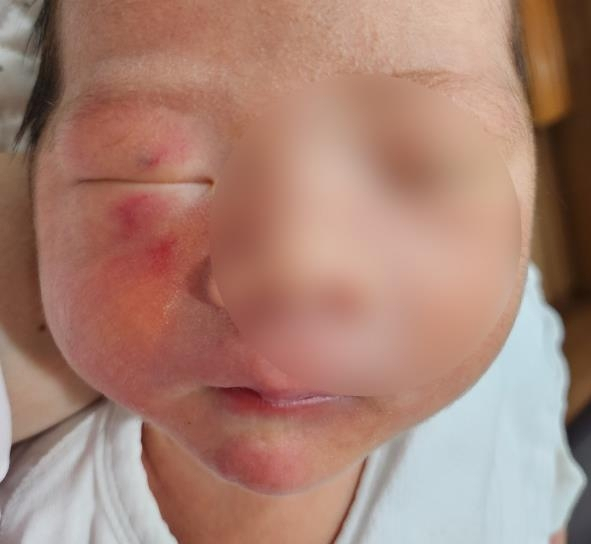 생후 4일 된 영아 얼굴에 난 상처.연합뉴스