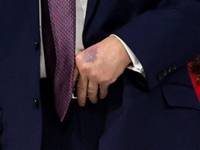 도널드 트럼프 미국 대통령의 왼쪽 손등에서 포착된 멍자국.로이터 연합뉴스