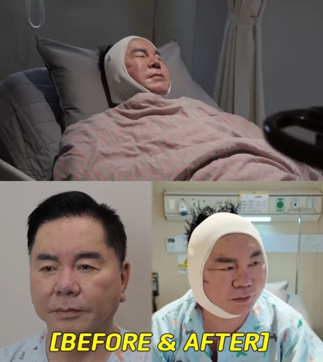 심형래, 안면 거상 수술 감행..달라진 얼굴 "평생 영구로 기억되길"[데이앤나잇]