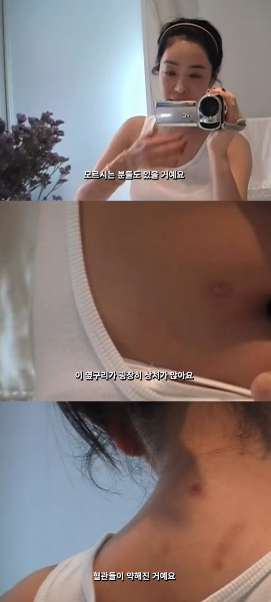 '폐암' <b>이혜영</b>, 수술 절제 부위→주사 흉터 공개 "안 예뻐서 속상" [스타...
