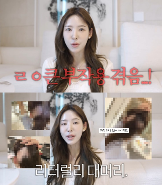 "JTBC 에어컨 안 나와" 발언한 이나연, 대머리 고백 "<b>모발 이식</b> 부작용"