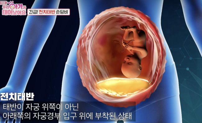 전치태반=사망위험↑..<b>손담비</b>, <b>과다출혈</b>까지.. 이규혁 '긴장+걱정' ('우...