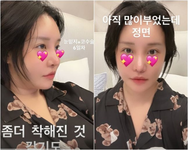랄랄, 코수술 6일만에 너무 예뻐져 깜짝, '이명화 못보나'