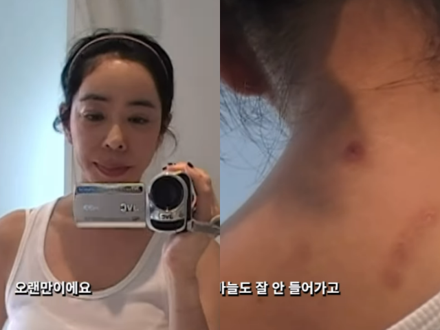 '폐암 투병' <b>이혜영</b> "옆구리 절제…온몸이 흉터투성이"