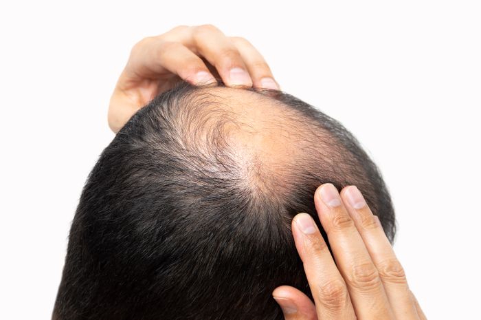 탈모 관련 이미지 ⓒ게티이미지뱅크