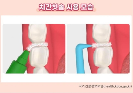 ◆…치간칫솔 사용법.