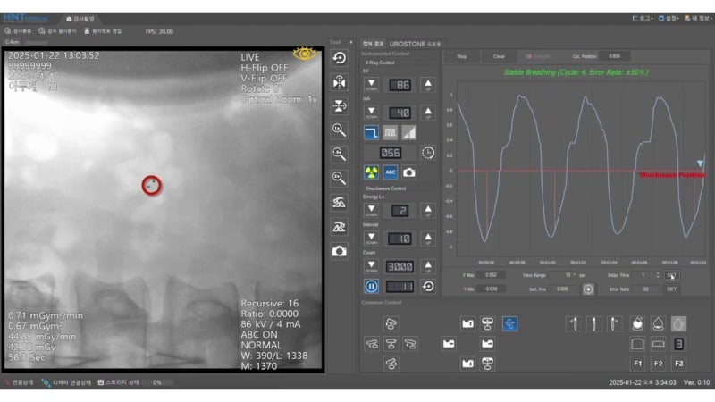 "Precise Treatment of Urinary Stones with AI Technology": Goldman Urology Introduces 'UROSTONE'