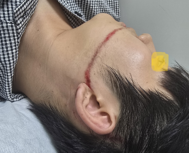 공연 중 <b>워터건</b> 맞고 피 '철철'...안산시·공연업체 고소