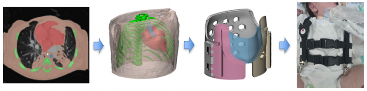 CT 영상,3D 모델링을 기반으로 한 맞춤형 흉부 보호대 제작 과정 이미지.서울아산병원