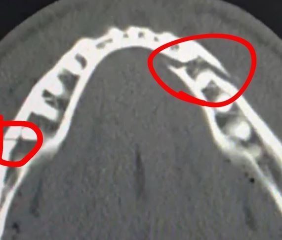 폴이 게재한 턱뼈 부상 사진.SNS 캡처