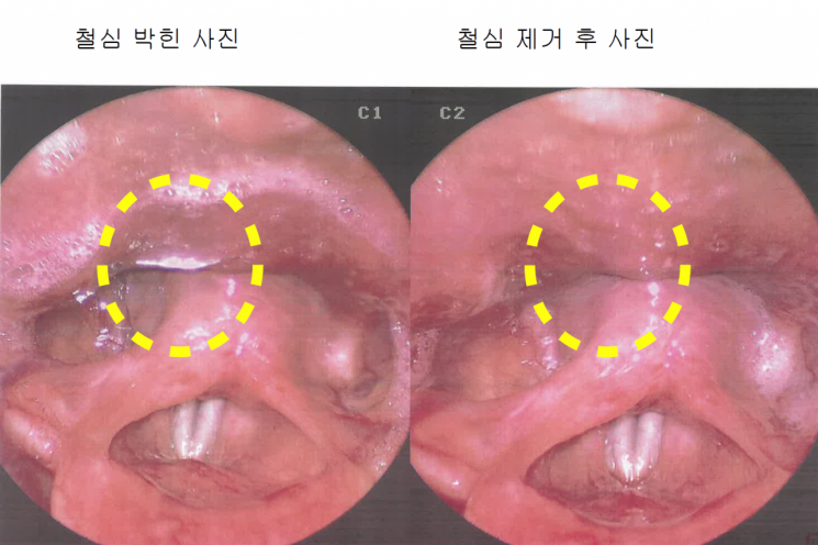 A씨의 병원 진료 기록에 첨부된 철사 제거 전후 후인두벽 모습.