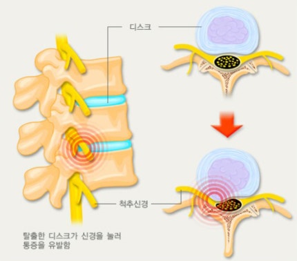 경추디스크는 목뼈의 디스크가 탈출하거나 파열돼 경추 신경을 압박하며 통증이나 마비 증상이 나타난다. [자료=대한의학회]