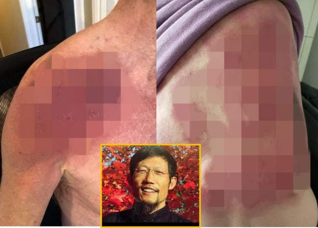 반복적으로 때려 큰 멍을 만들고 피를 흘린다. 때려서 생긴 멍이 '독소 혈액'을 표면으로 끌어올리고 화학적 독소를 배출해 병을 낫게 한다는 원리의 '파이다 라진 '사이비 과학. 이를 창시하고 설파한 홍치 샤오(하단 