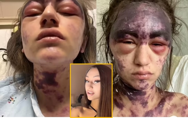 희귀 면역질환을 앓고 있는 한 20대 여성이 치료를 받기 위해 병원에 갔다가 백신 3가지를 한꺼번에 맞고 끔찍한 부작용에 시달린 사연이 공개됐다. [사진=영국 데일리메일 보도 갈무리]