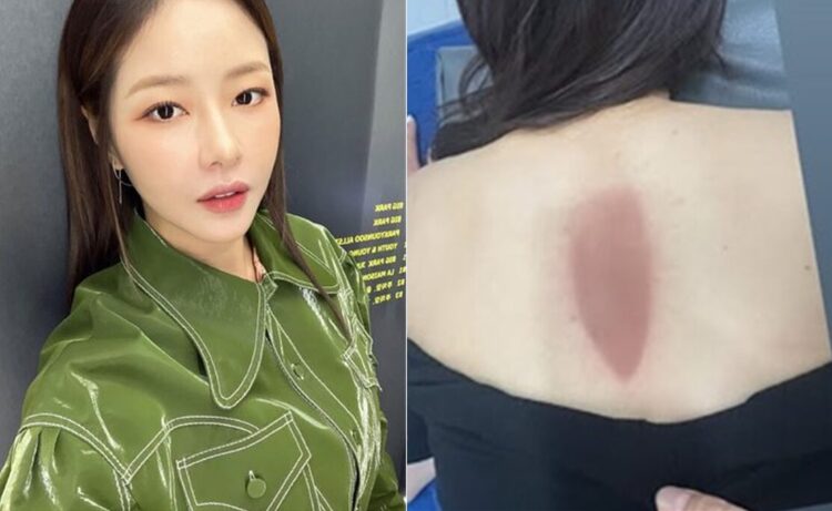 배우 박하나가 신혼여행 후 화상을 입었다.[사진=박하나 인스타그램]