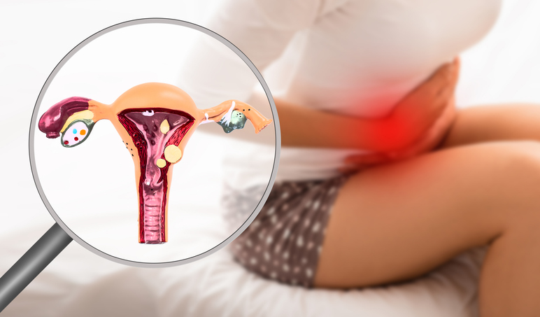 성관계 통증이나 생리불순을 단순하게 볼 것이 아니다.여성의 10-30%가 겪는 난소낭종일 수도 있다.단순한 기능성 낭종은 대부분 자연스럽게 사라지지만 병리적 낭종은 골반통 등 극심한 통증을 동반하며 드물지만 암 