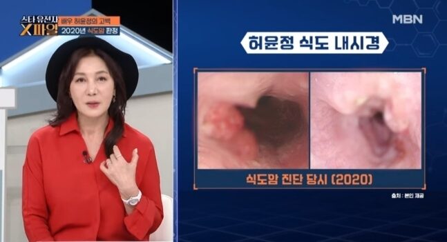 배우 허윤정이 식도암을 진단받고 식도 24cm를 절제한 사실을 고백했다.[사진=MBN '임성훈의 스타 유전자X파일']