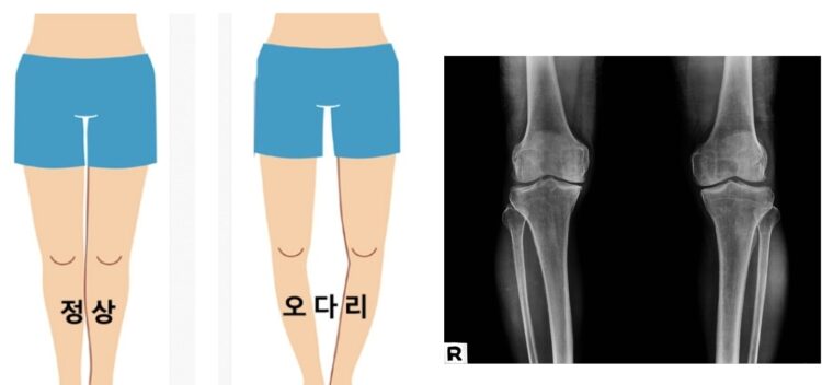 오다리는 퇴행성 관절염을 일찍 불러오는,또 다른 원인이기도 하다.[사진=부산큰병원]