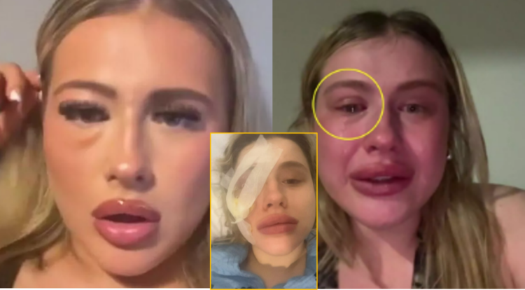어린 시절부터 한쪽 눈이 어둡게 보이고 부어오르는 증상을 겪어온 10대 소녀가 인공 속눈썹을 붙이며 부기를 가려 왔지만 수년 뒤 자신이 희귀암에 걸렸다는 사실을 뒤늦게 알게 된 사연이 공유됐다.결국 한쪽 눈을 제거