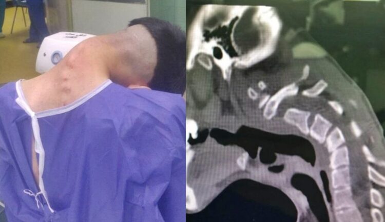 수년 간의 약물 남용으로 인해 목이 가슴에 닿을 정도로 경추가 변형된 사례가 보고됐다.[사진=Clinical Case Reports]