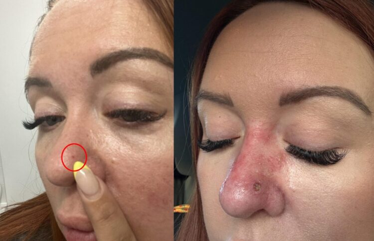 한 여성이 콧등에 생긴 작은 붉은 점을 단순한 여드름으로 여기고 넘겼다가, 두 차례에 걸쳐 피부암 진단을 받은 사연이 전해졌다. [사진=SNS]