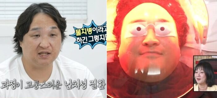 구성환이 앓는 백반증은 색소를 만드는 멜라닌 세포가 파괴돼 피부의 일부가 탈색되는 병이다. 우리나라에도 매년 6만 명 이상의 환자가 백반증으로 진료받고 있다. 사진=MBC '나 혼