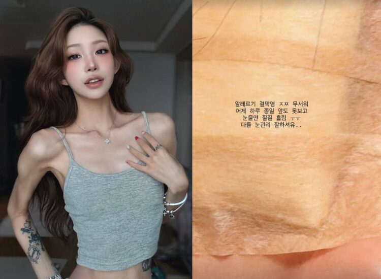 최준희가 알레르기 결막염에 걸렸다고 말했다.사진=최준희 인스타그램