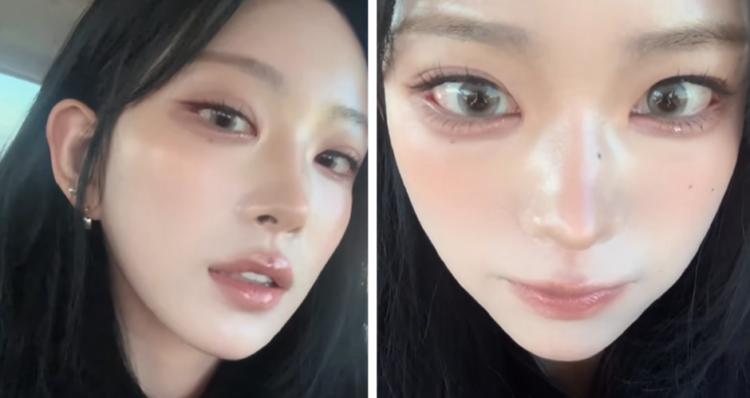 7월 뒤밑트임 수술로 눈꼬리를 내려 눈꼬리가 안구에 밀착되지 않는 모습.눈꺼풀이 안구에 제대로 밀착되지 않으면서 눈물이 흐르거나 눈이 마르고,이물감과 피로감 같은 기능적 불편함이 나타날 수 있다.사진=최준희 S