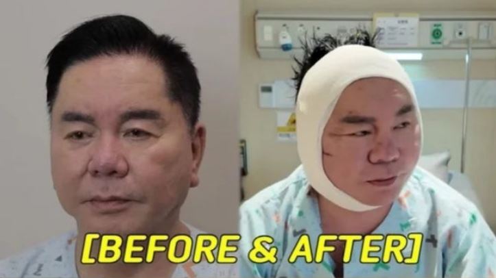 심형래가 안면거상술을 받은 전후 모습.사진=유튜브 채널 '영구TV' 영상 캡처