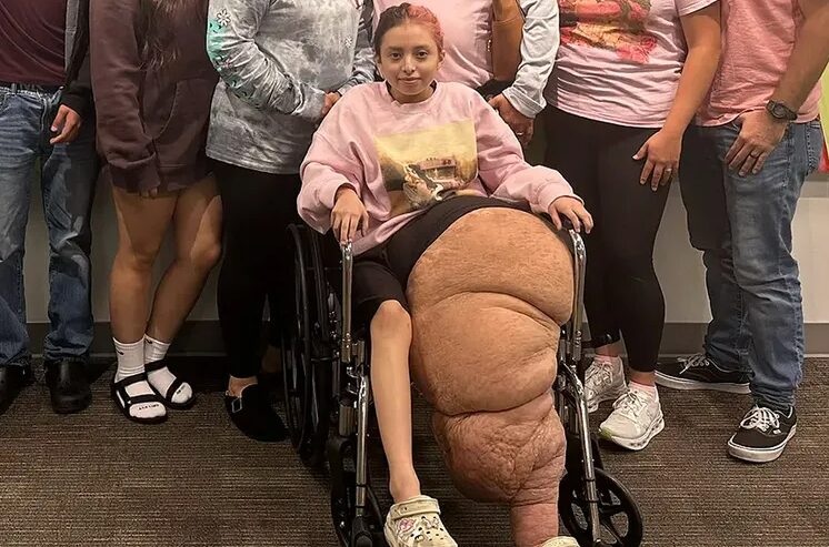 재스민 라미레즈의 왼쪽 다리는 두 살 무렵부터 비정상적인 성장을 보였다.절단한 다리의 무게는 80kg에 달하는 것으로 전해졌다.사진=GoFundMe