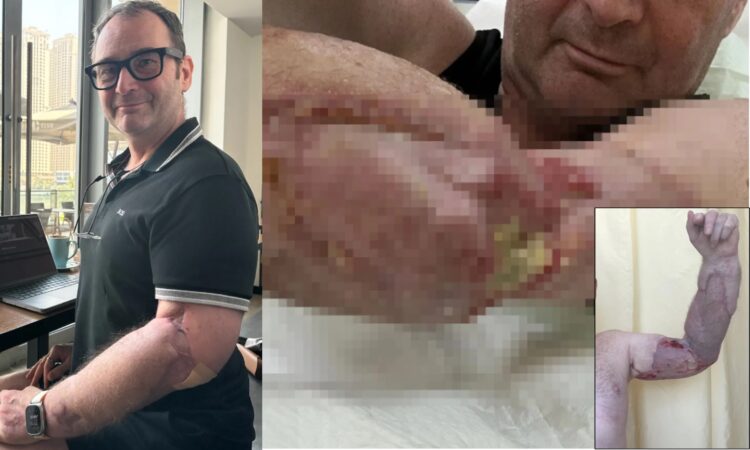 평소 운동을 즐기며 건강에 자신 있던 한 50대 남성이 단순한 인후통 겪은 후 치사율 20%에 달하는 세균에 감염돼 팔을 거의 절단해야 한 순간까지 간 사연을 공유했다.괴사성 근막염 이후 팔에 근육과 지방을 이식해