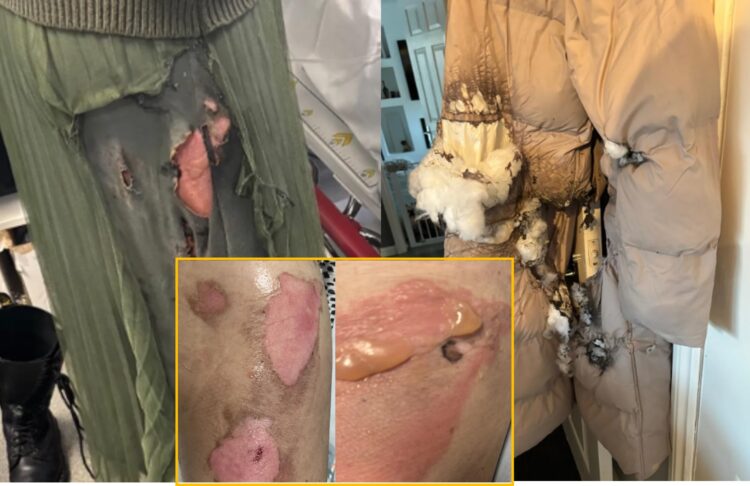 운전 중에 코트 주머니에 넣어둔 전자담배가 갑자기 폭발하면서 다리에 화상을 입은 50대 여성의 사연이 전해졌다.사진=케리로버츠 SNS