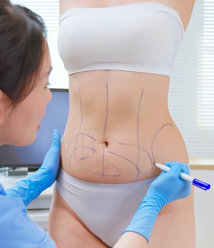 지방흡입(Liposuction) 수술에 앞서 '디자인 그림'을 그리고 있다.미국의 저명한 성형외과 의사가 '점심시간 지방흡입' 수술의 위험성을 경고하고 나섰다.사진=게티이미지뱅크