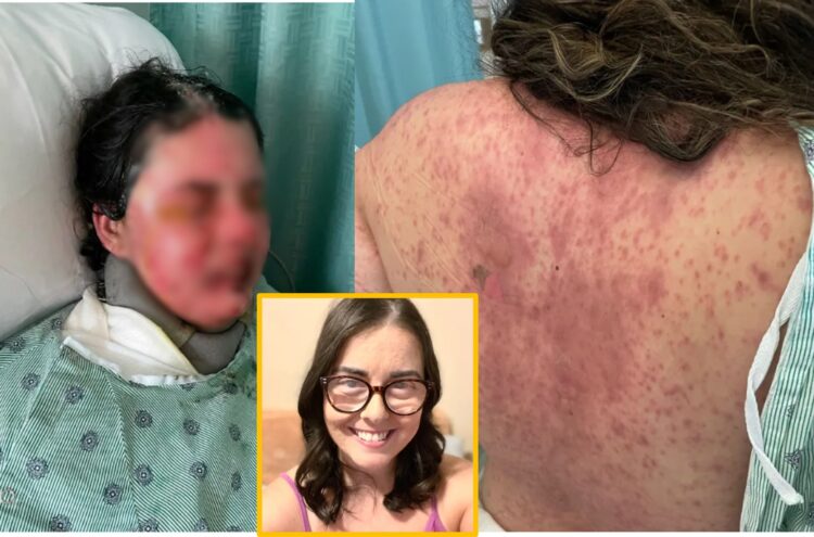 흔히 처방되는 항경련제 복용 이후 발생한 희귀 중증 약물 부작용으로,30대 여성이 전신 피부의 대부분을 잃고 영구적 실명에 이른 사례가 보고됐다.사진=SNS