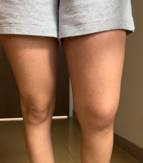 스피닝 후 횡문근융해증이 발생하면서 한 쪽 허벅지가 부어오른 모습.사진=clinical case reports