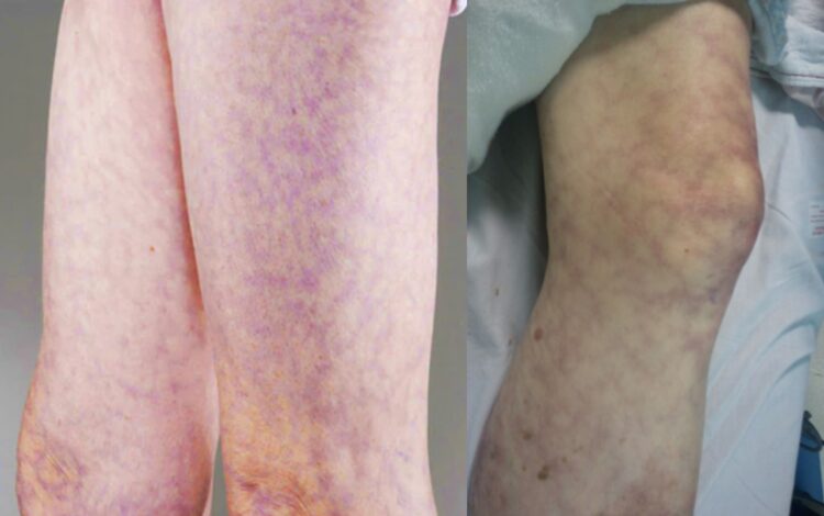 피부에 푸르거나 보랏빛의 그물 모양 무늬가 나타난다면,단순한 혈액순환 변화가 아니라 동맥이 막히는 심혈관 질환의 신호일 수 있다는 경고가 나왔다.좌측 사진=메이요 클리닉 / 우측=스탠포드 메디신