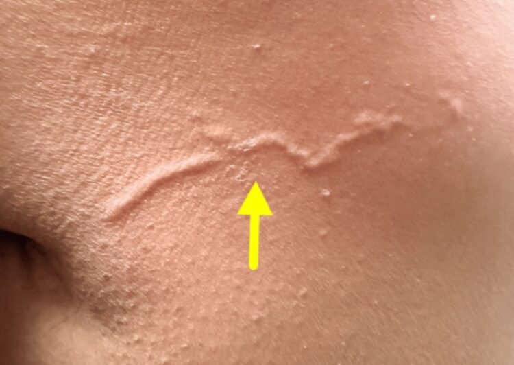 40대 여성 등에 나타난 피부 유충 이행증 병변. 사진=큐레우스(cureus)