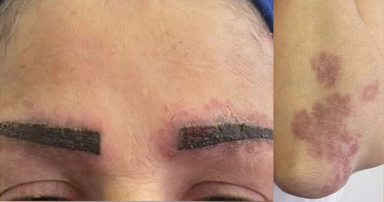 눈썹 문신 이후 보라색 피부 발진이 나타나더니, 전신 면역질환으로 이어진 사례가 학술지에 보고됐다. 사진=Oxford Medical Case Reports