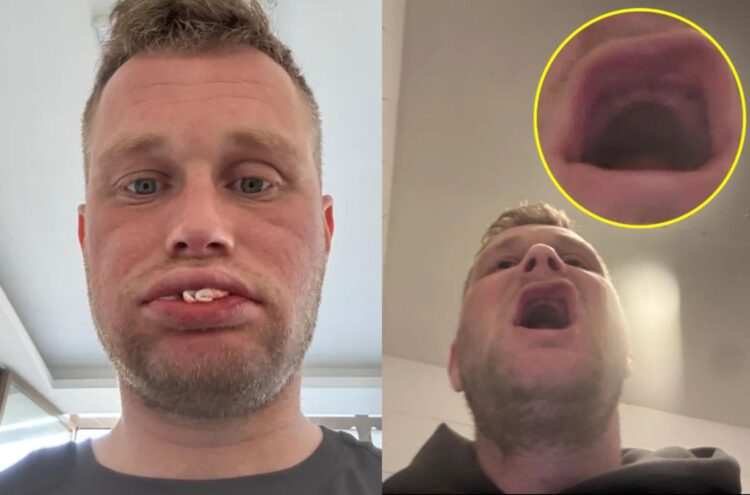 튀르키예에서 임플란트 시술을 받은 40대 남성이 웃다가 임플란트가 다 빠져서 재방문했지만, 황당하게도 치과에서 치아를 모두 제거해 버렸다는 사연을 전했다. 사진=고펀드미